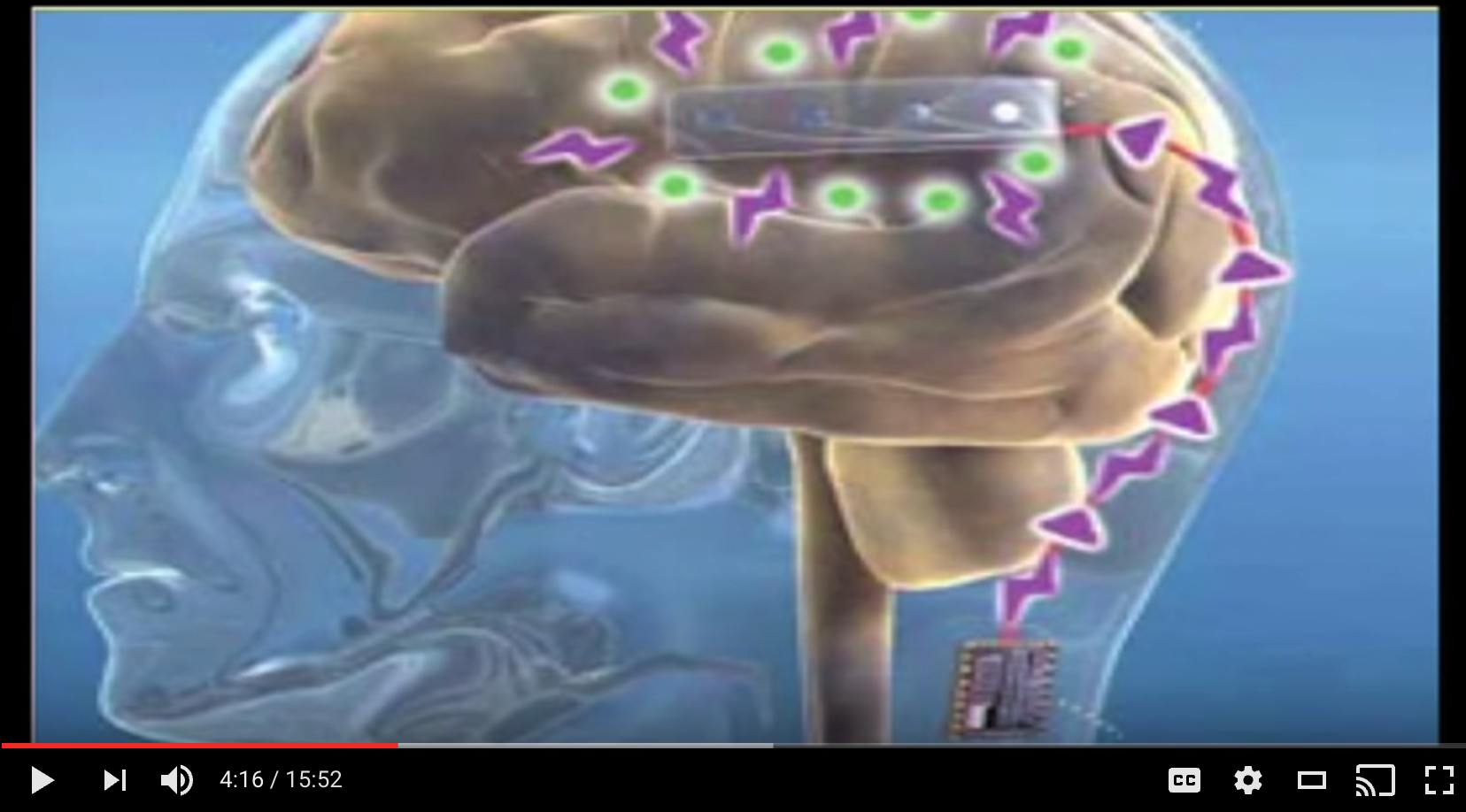 iphone in brain